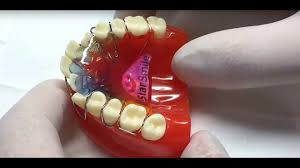 пластины для зубов